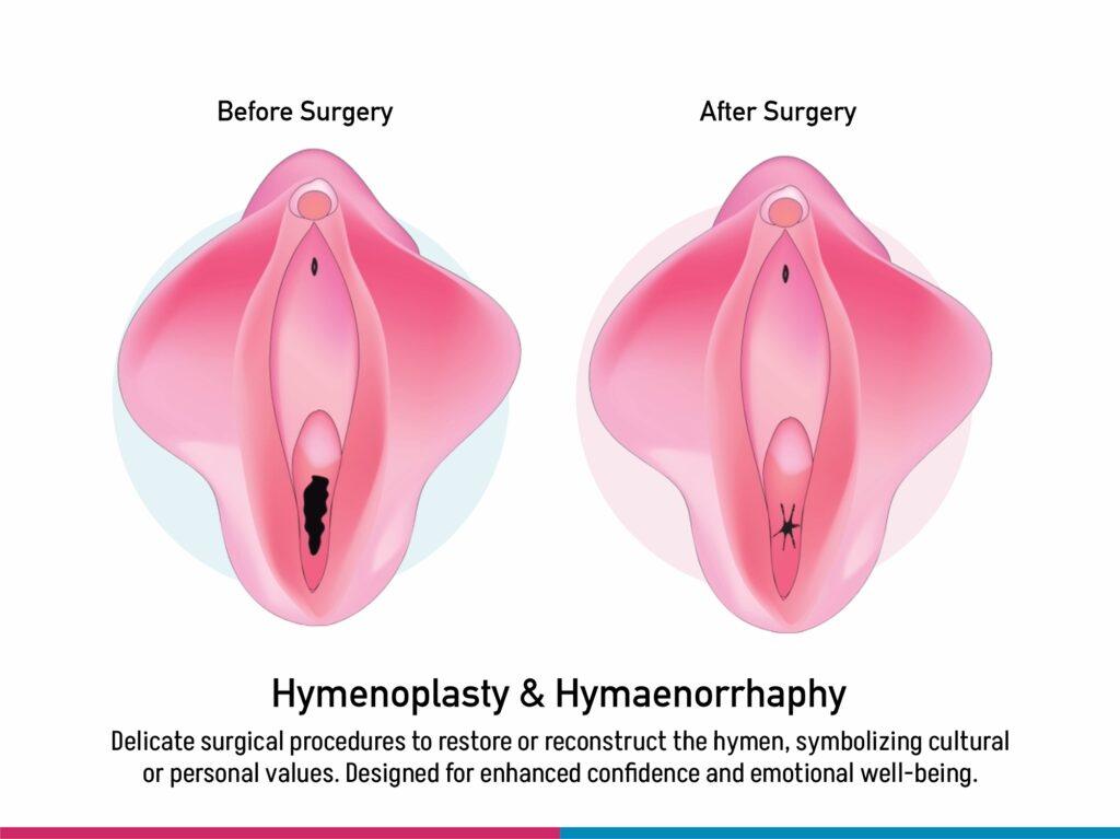 Hymenoplasty Hymenorrhaphy