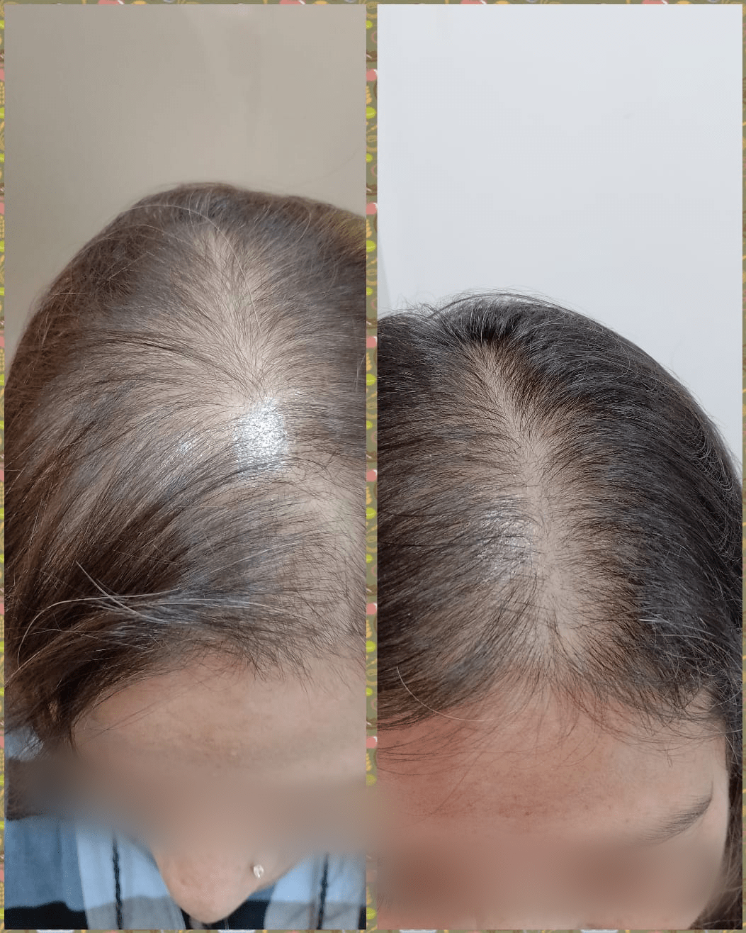 Hair Treatement PRP with GFC