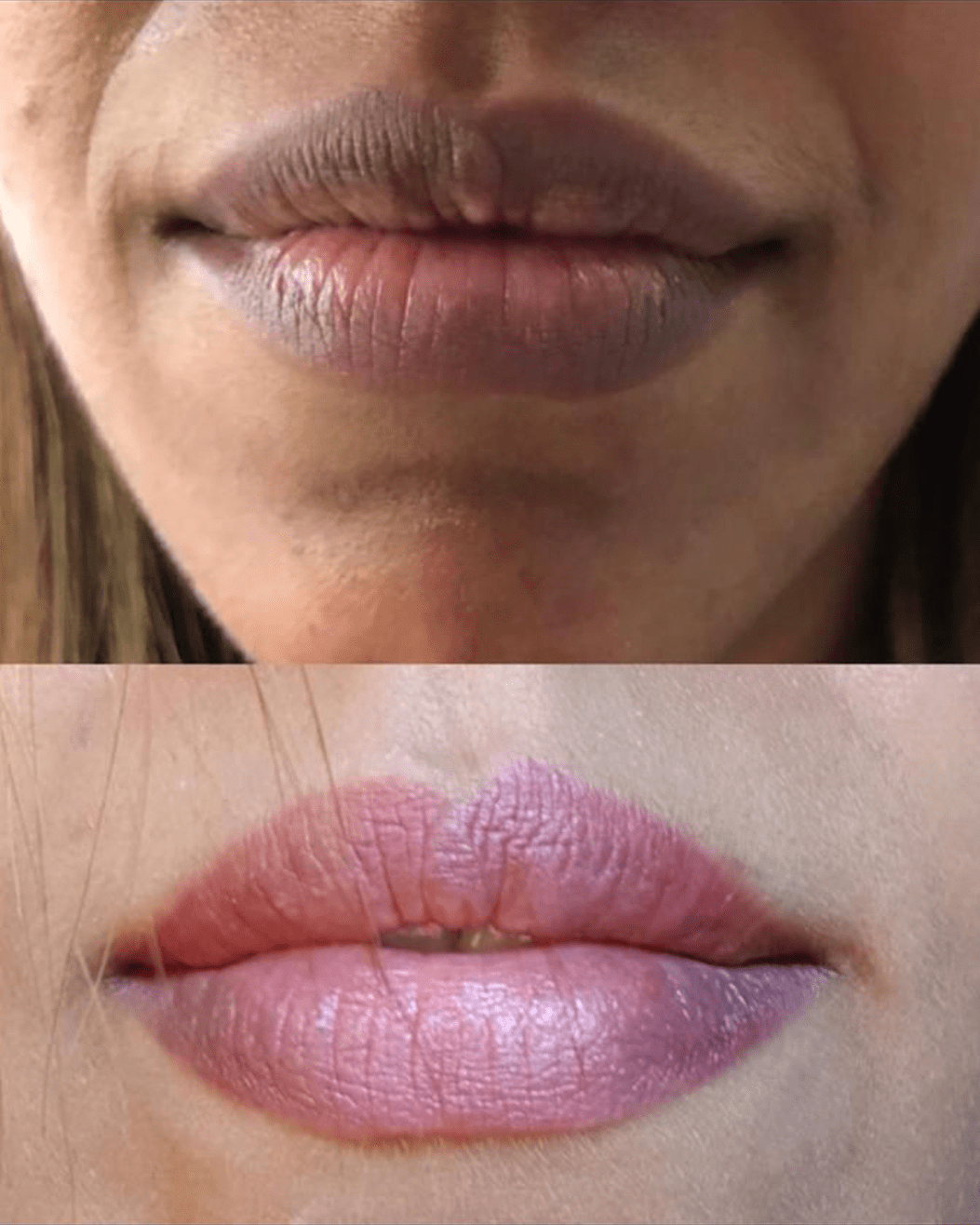 Lip LIghtening with Qswitch Laser