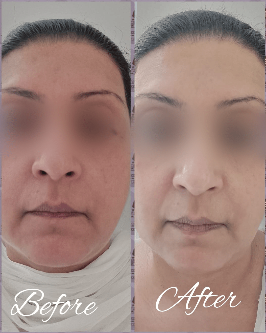 O3 Anti Agening Facial