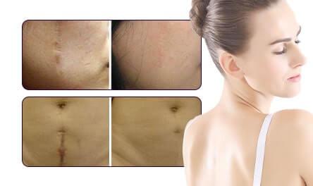 CO2 Fractional Laser | Skin Care | Hair Care | Cosmetic Gynecology treatment Clinic In Mumbai Scar Removal-min