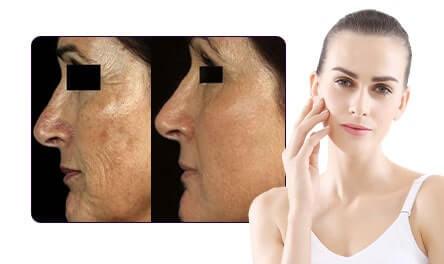 CO2 Fractional Laser | Skin Care | Hair Care | Cosmetic Gynecology treatment Clinic In Mumbai Wrinkle Removal-min